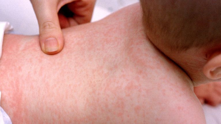 Rash to back of baby with a thumb touching