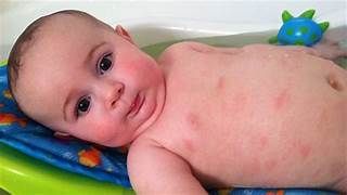 Baby with rash on body