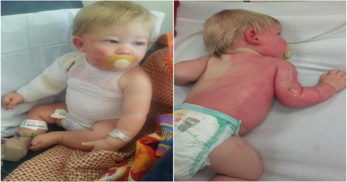 Babies with burns on body
