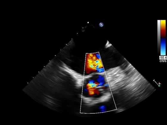 Ecocolordoppler