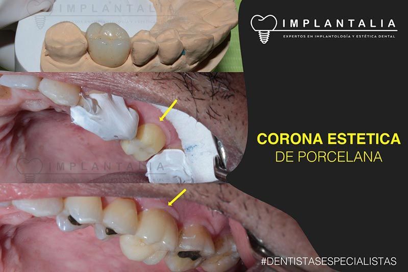 IMPLANTALIA