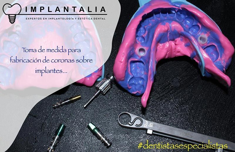 IMPLANTALIA