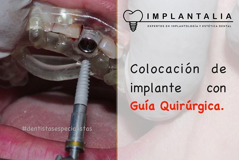 IMPLANTALIA