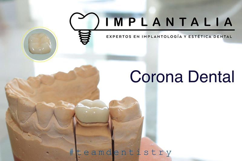 IMPLANTALIA