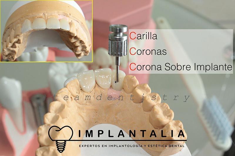 IMPLANTALIA