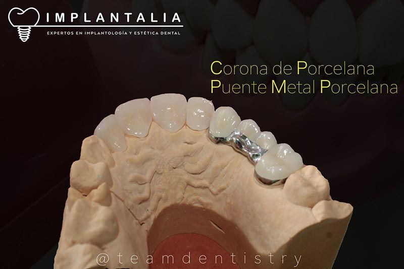 IMPLANTALIA