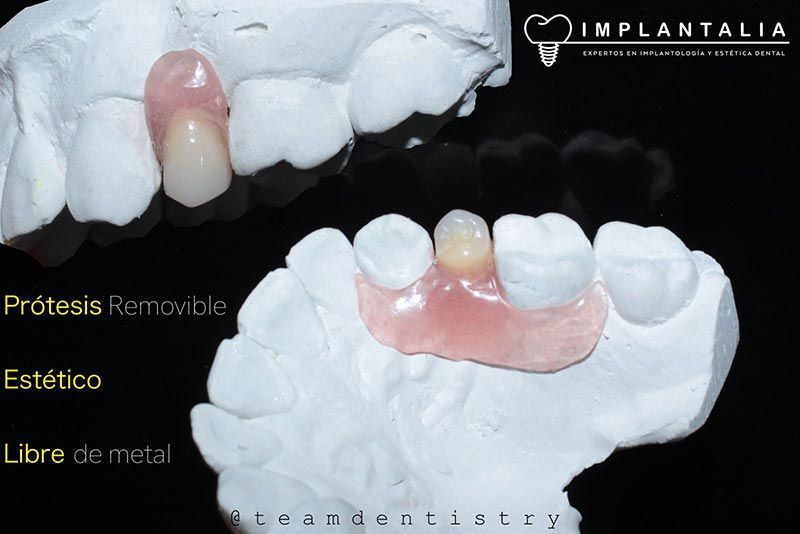 IMPLANTALIA