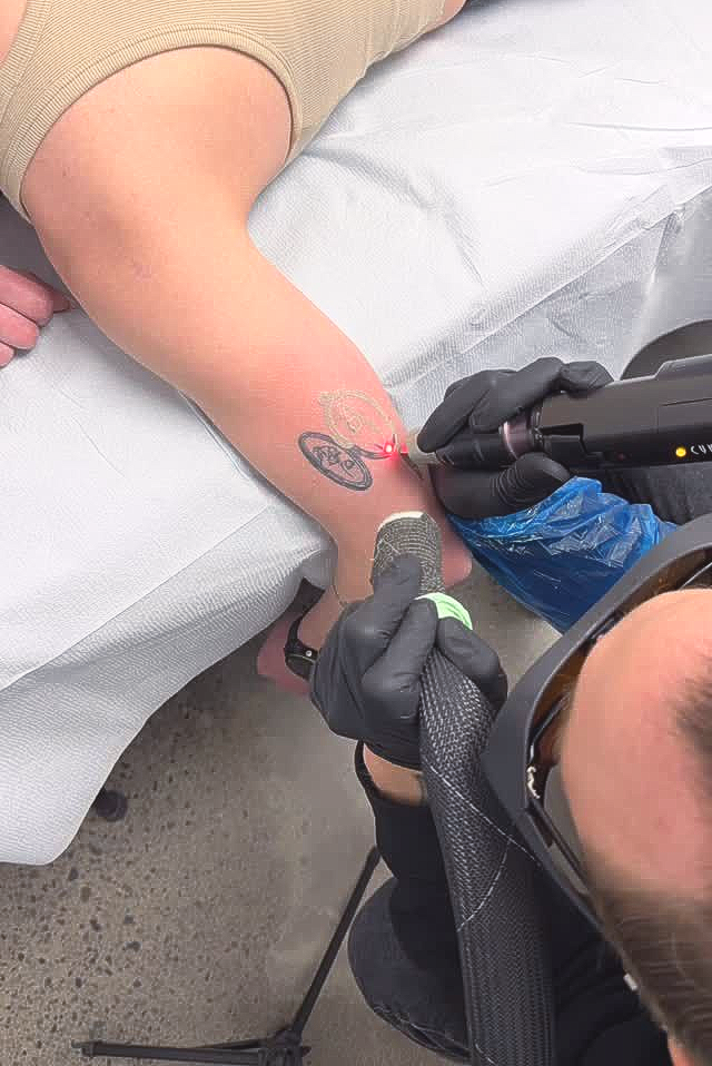 A technician uses a laser device to remove a small tattoo on a person's forearm while using a cold air cooling tool.