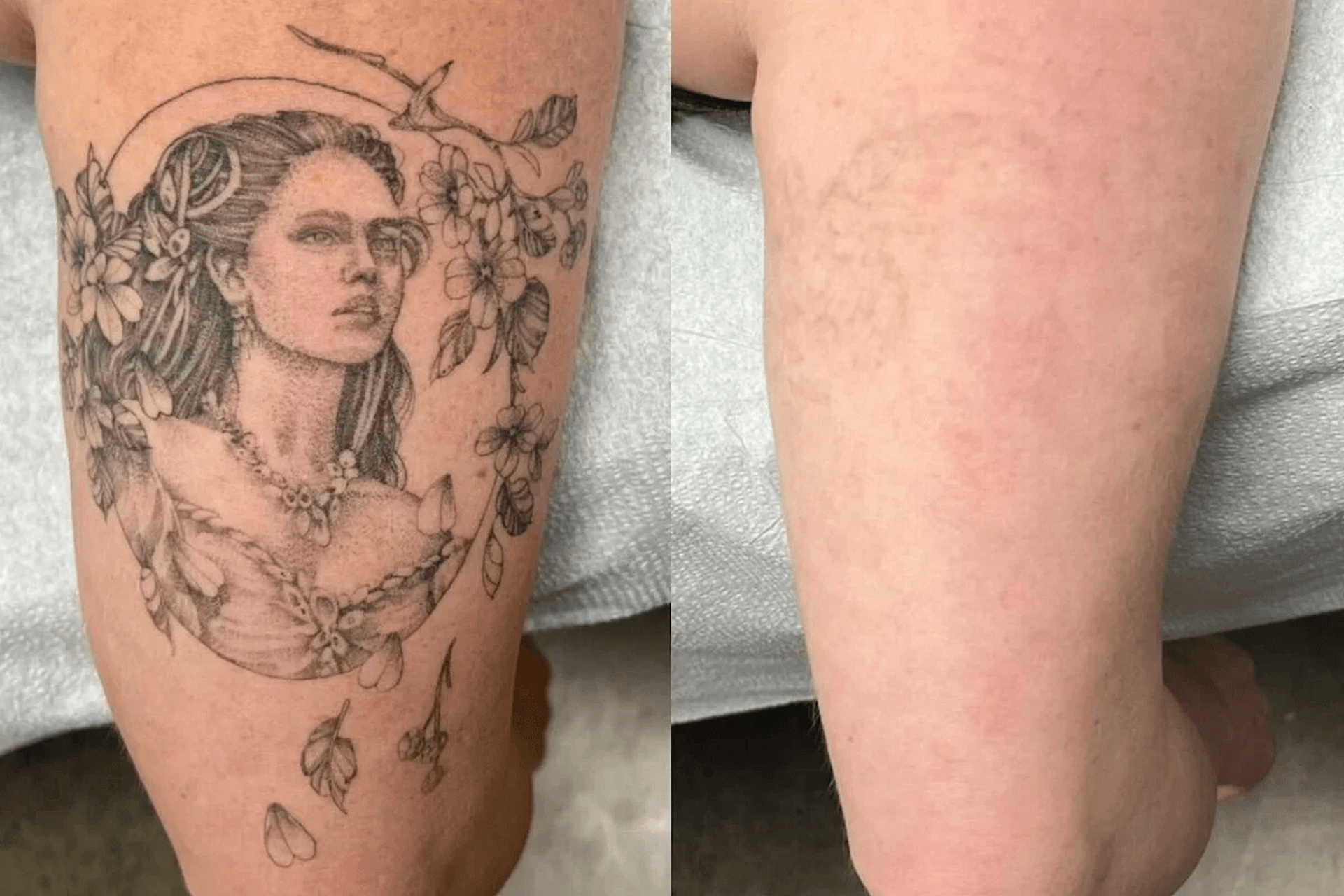 Before-and-after comparison of a tattoo on a person's arm, showing a detailed illustration removed to reveal clear skin.