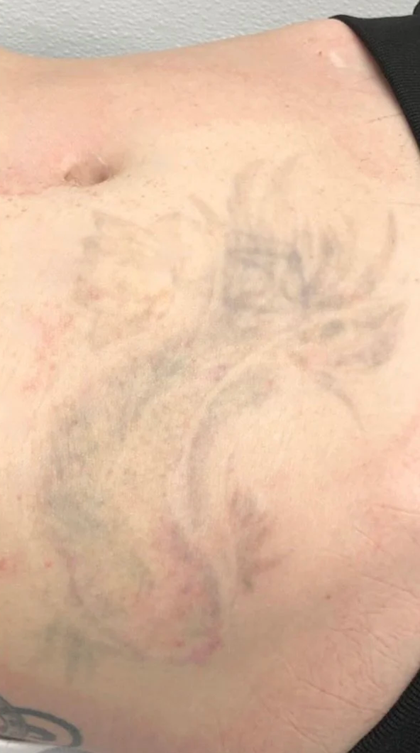 Close-up of a pale stomach with faint gray and red bruising or skin markings