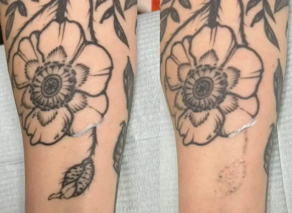 Two images of a tattoo before and after laser removal, showing a floral design on a forearm.
