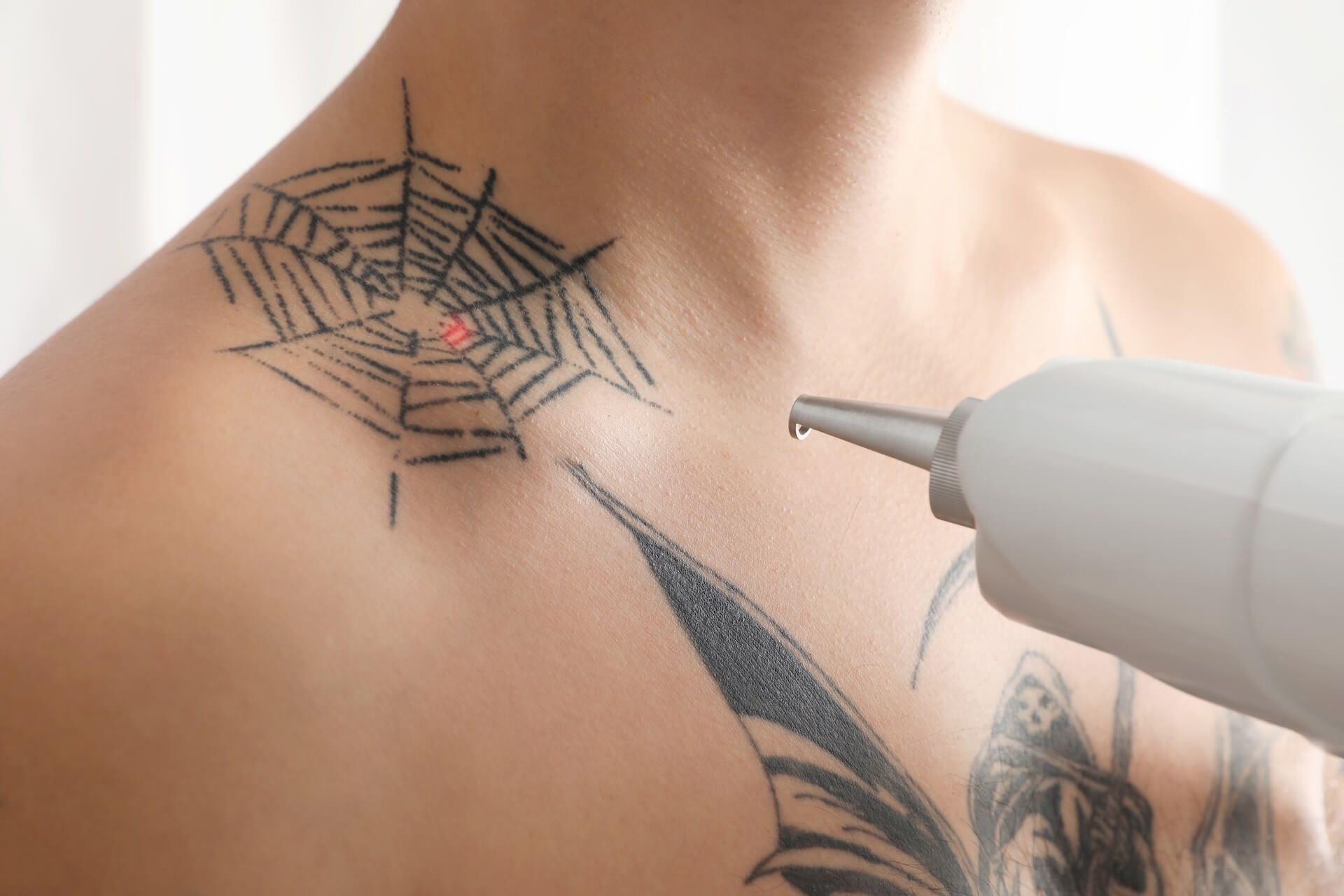 Does laser tattoo removal hurt removal process on a persons chest and clavicle