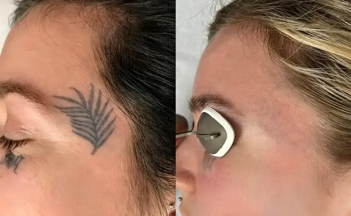 Side-by-side close-up of a temple tattoo and a handheld magnifier examining the skin