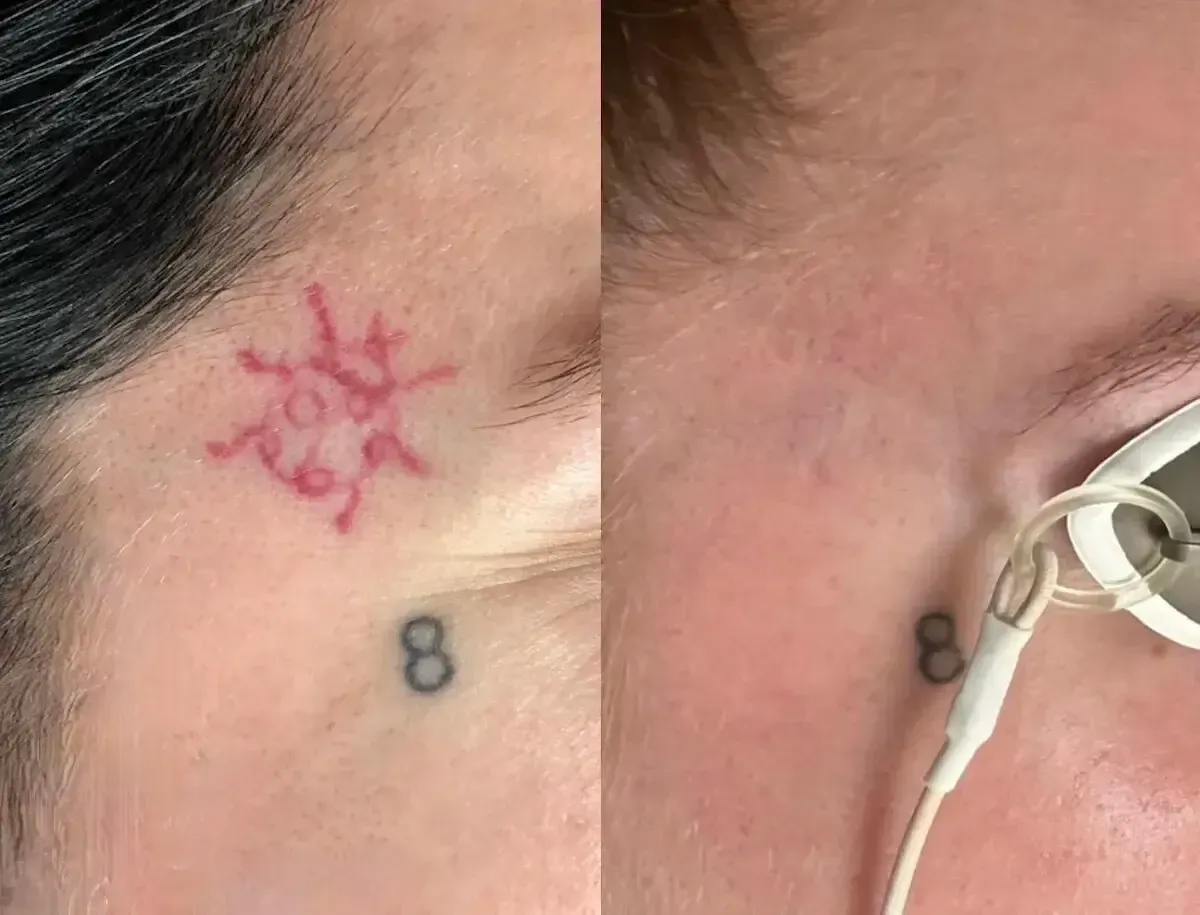 Close-up of a temple with a red star tattoo and small black “8” tattoos near the eye, wearing white earbuds