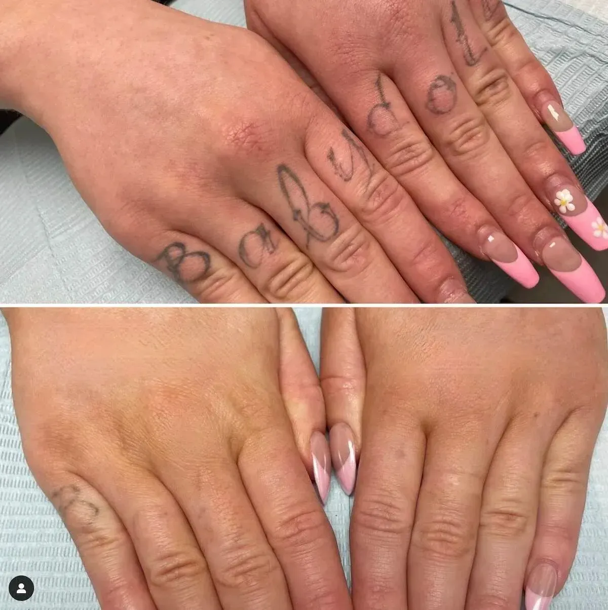 Before-and-after photos of a laser tattoo removal treatment on a hand with finger tattoos.