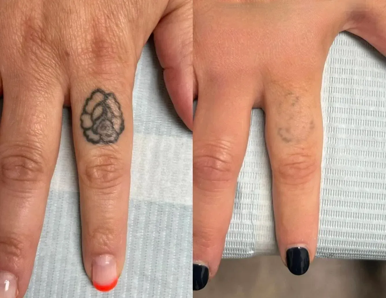 Before and after comparison of a finger tattoo being removed by laser treatment.