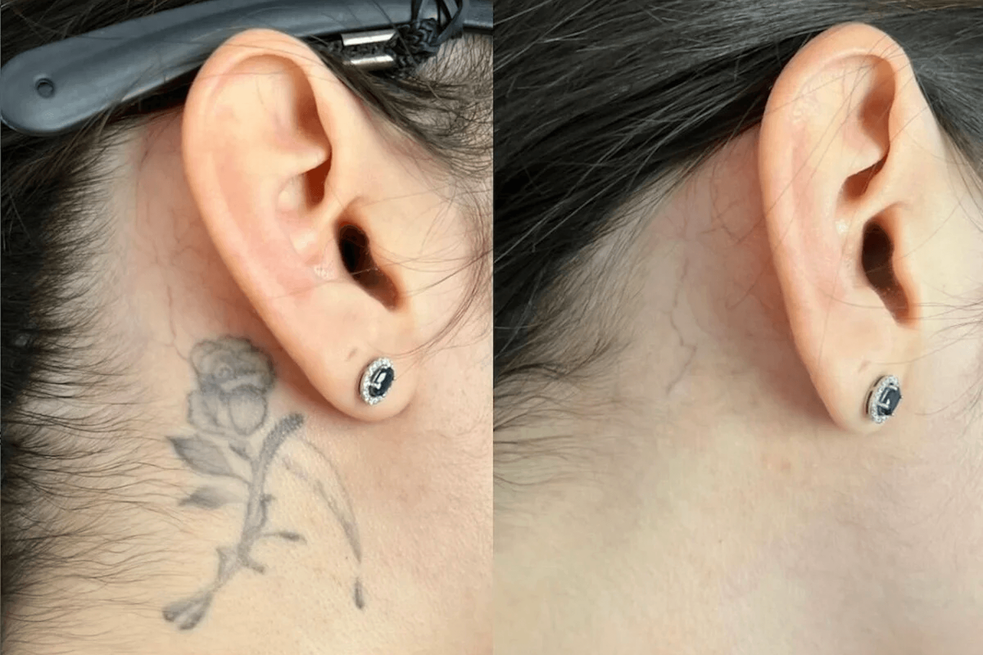 Before and after comparison showing the successful removal of a small rose tattoo behind a person's ear.