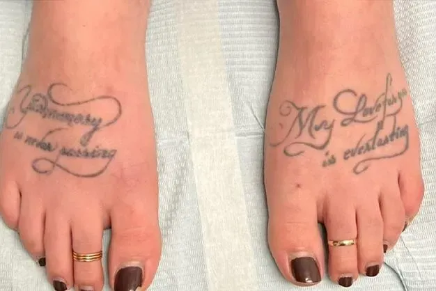 Feet with matching tattoos: Brown nail polish, gold toe rings. Tattoo Removal