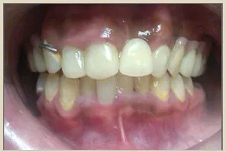 After Crown Restoration — Columbia, SC — University Dental PA