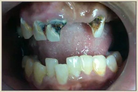 Before Crown Restoration — Columbia, SC — University Dental PA
