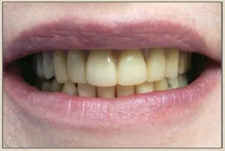 After Dental Cleaning — Columbia, SC — University Dental PA