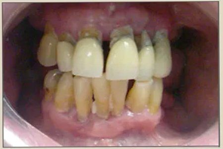 Before Dental Cleaning — Columbia, SC — University Dental PA