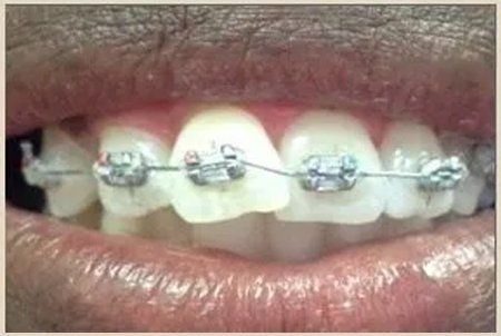 During Braces — Columbia, SC — University Dental PA