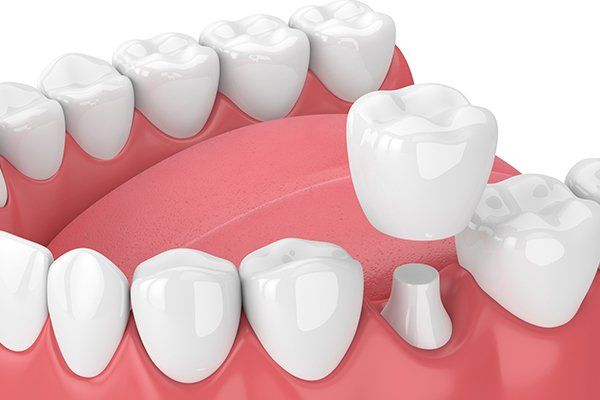 Dental Crown — Columbia, SC — University Dental PA