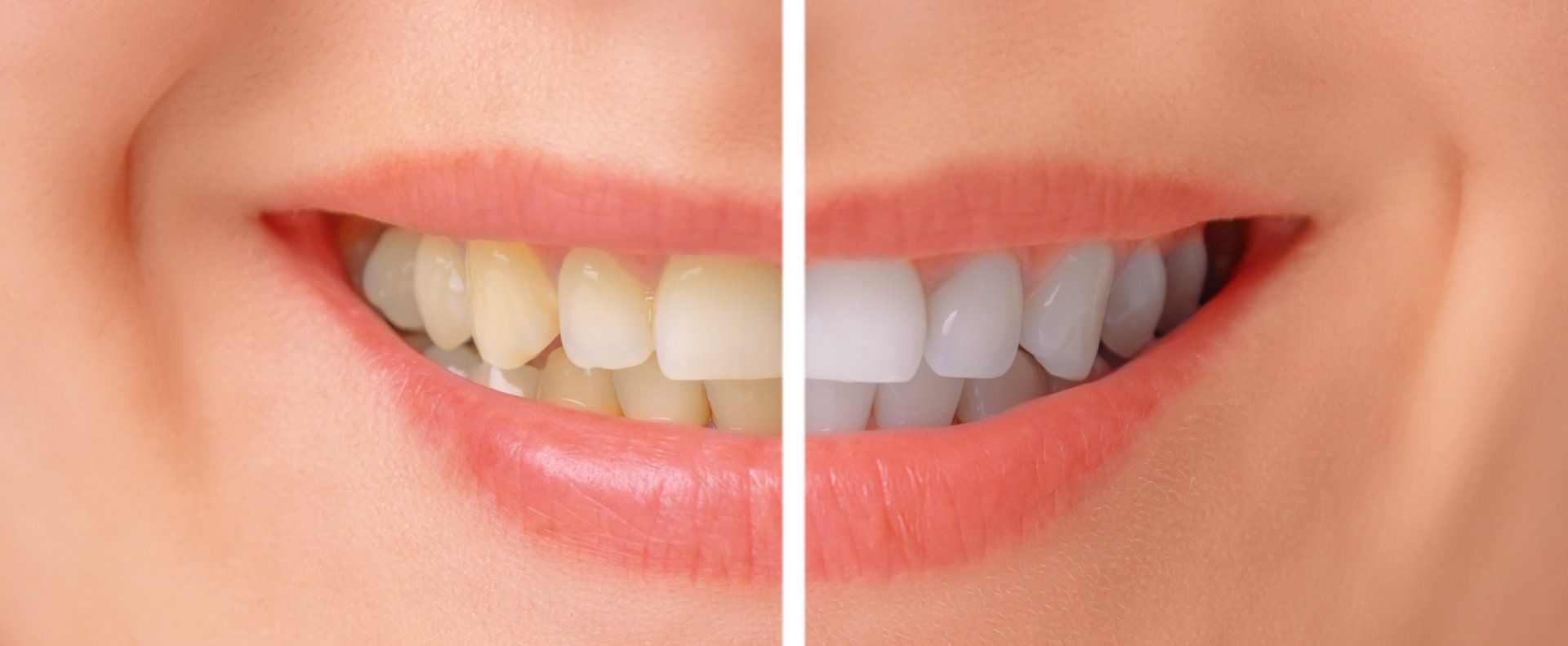 The Couple Has White Teeth — Columbia, SC — University Dental PA