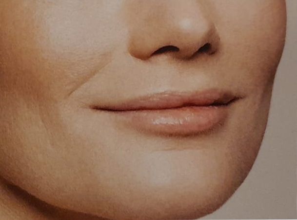 filler labbra