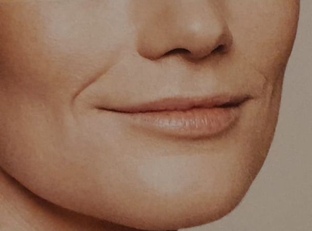 filler labbra