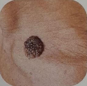 Verruca Seborroica