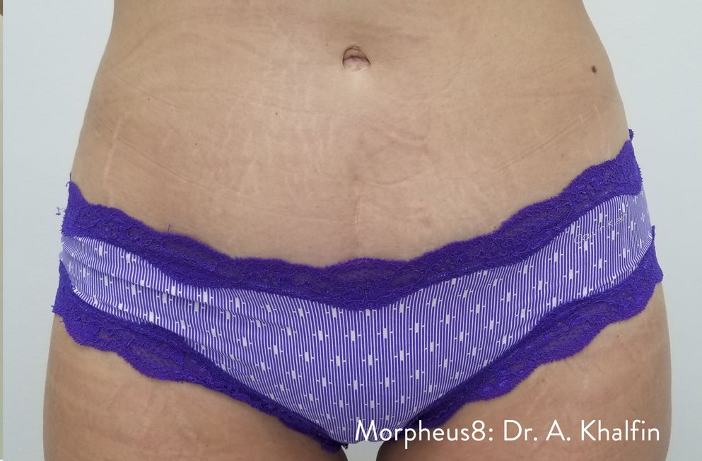 Abdomen with stretch marks and purple lingerie. Text in lower corner: Morpheus8: Dr. A. Khalfin.