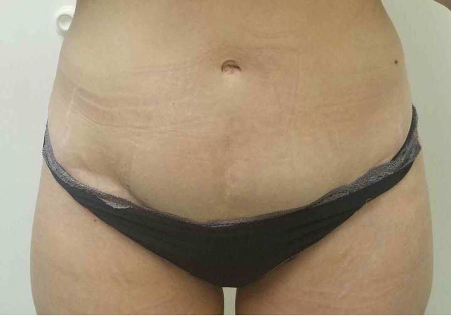 A person's midriff area showing stretch marks, and underwear.