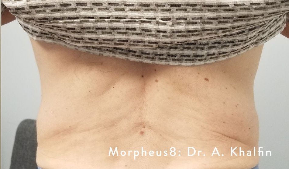 Back skin with wrinkles and some moles, text: Morpheus8: Dr. A. Khalfin.