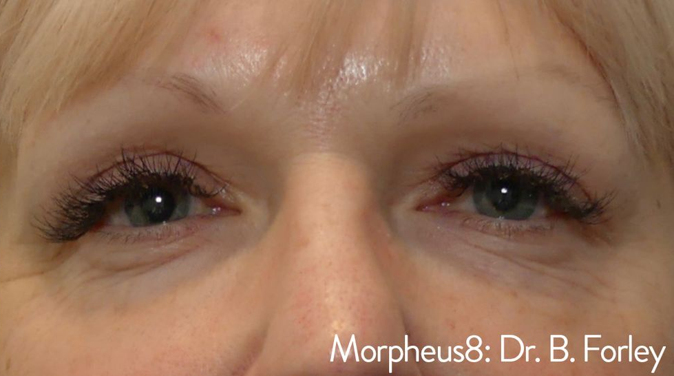 Close-up of a person's eyes, after Morpheus8 treatment. The eyes are open with long lashes.