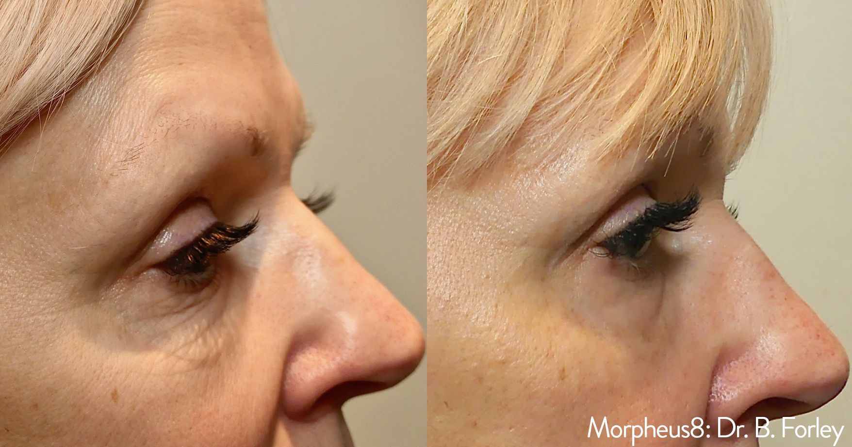 A before and after photo of a woman 's face.