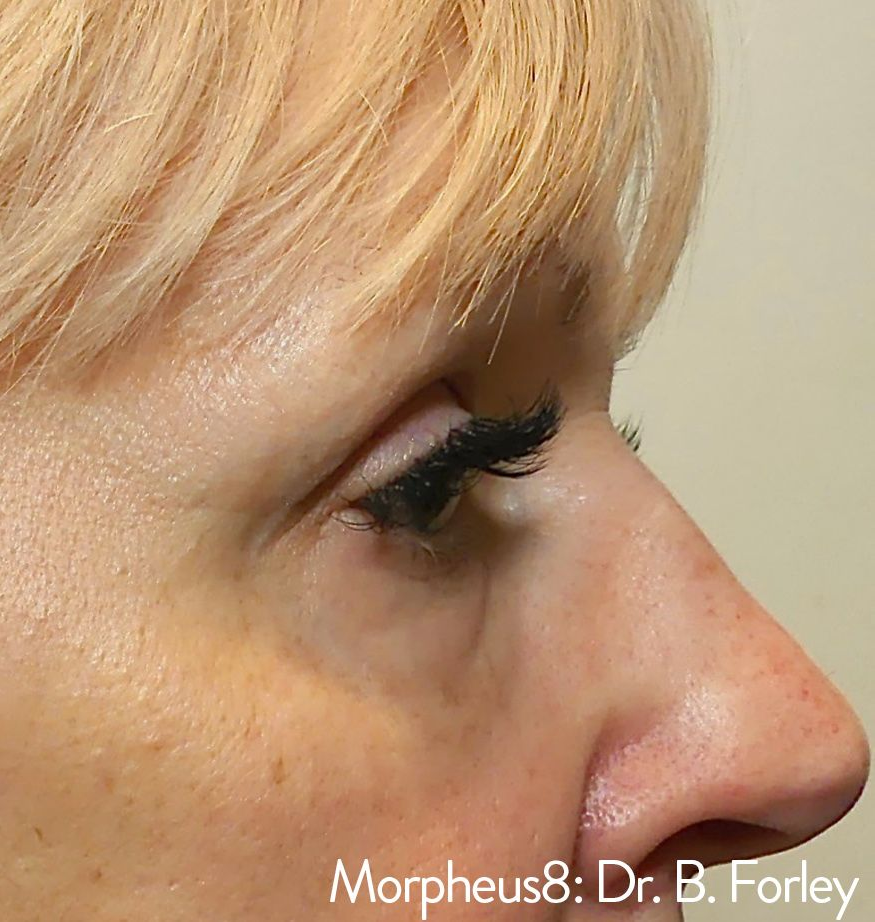 Profile view of a person's face, showing eye, nose, and skin, with a text overlay for Morpheus8 treatment.