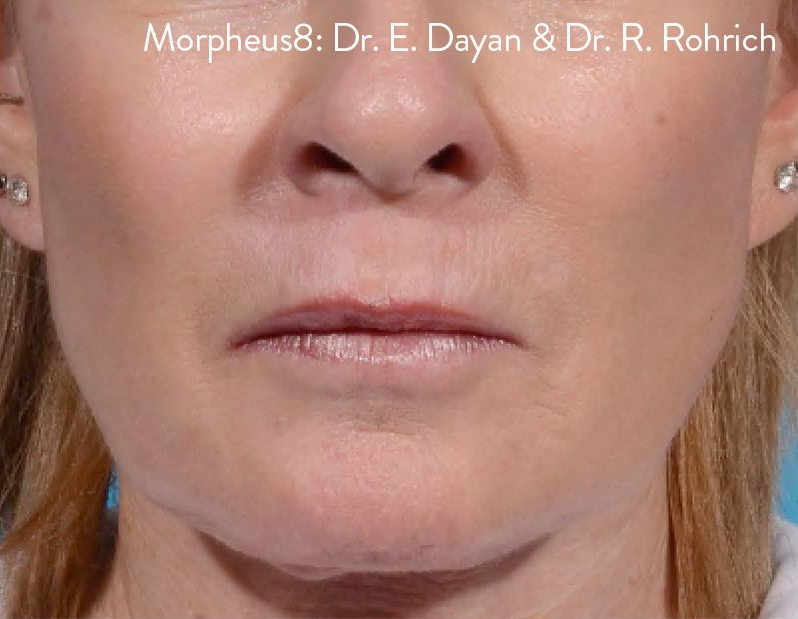 Close-up of a woman's lower face, showing lips, nose, and skin, labeled 
