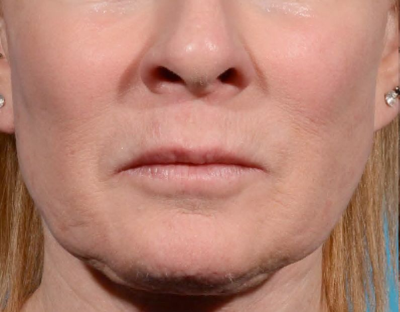 Close-up of a person's face showing signs of aging: wrinkles, sagging skin, and thin lips.