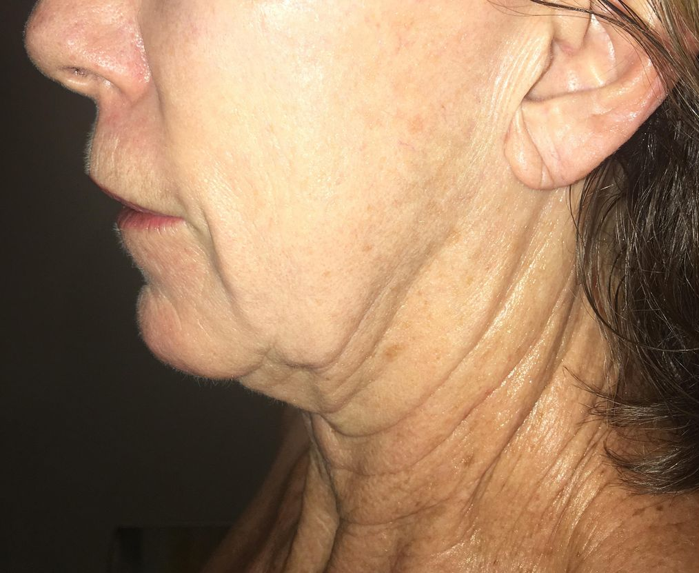 Profile view of a person's neck and jaw, showing skin wrinkles and folds.
