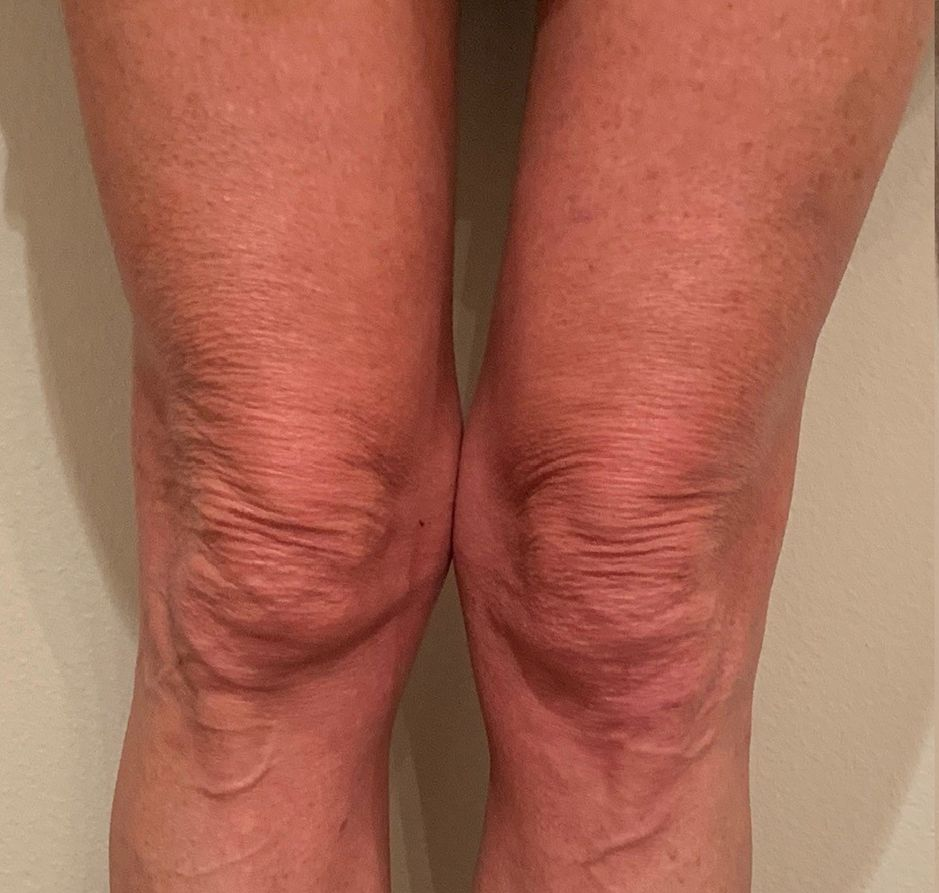 Close-up of two human knees. Skin appears dry and wrinkled, with visible veins.