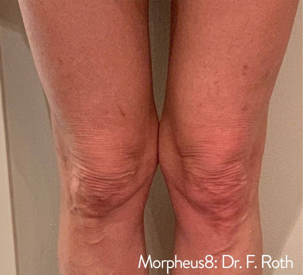 Front view of knees, showing skin texture and slight discoloration, with 