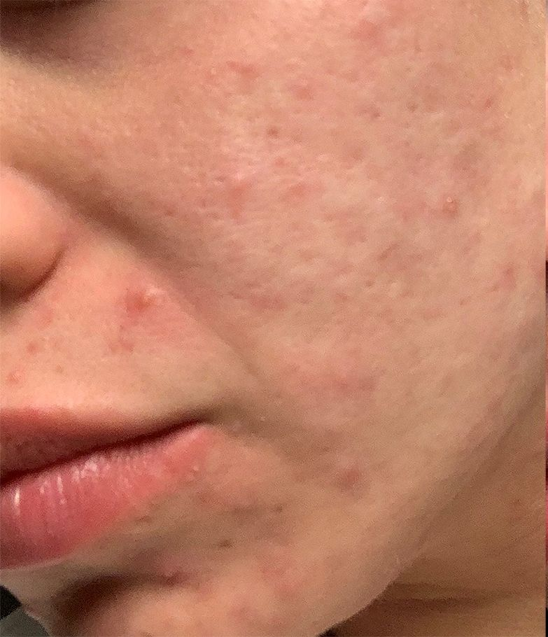 Close-up of a person's cheek and mouth. Skin has visible acne and some scarring, appearing red.