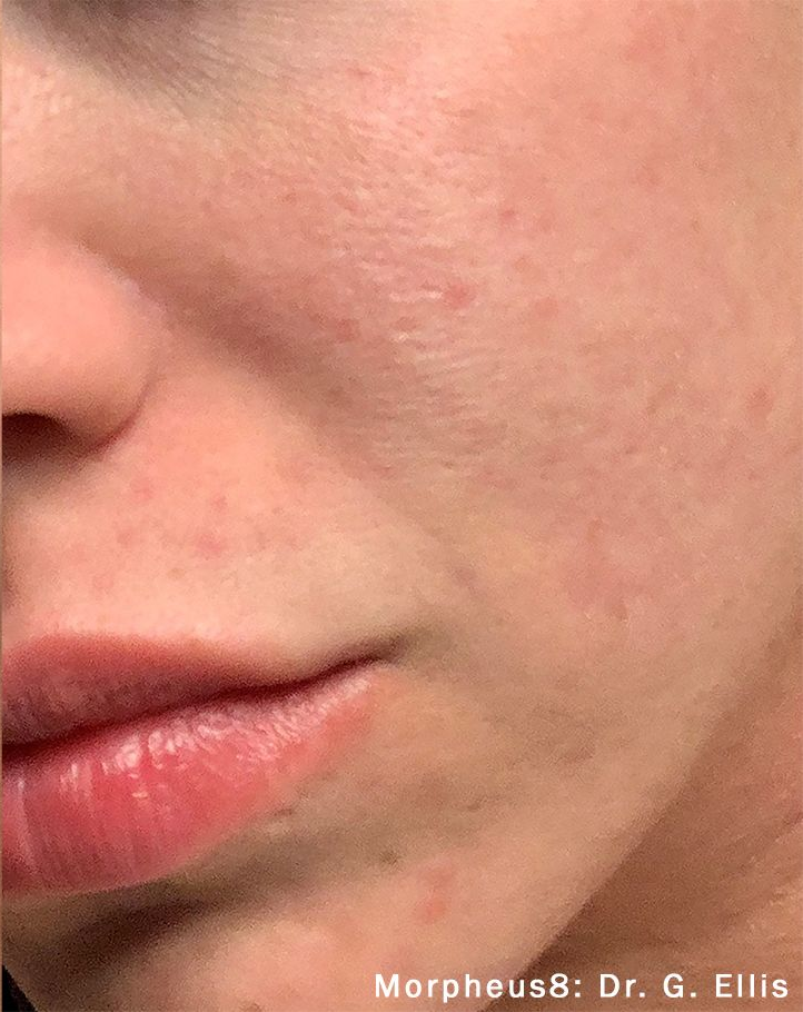 Close-up of a person's cheek and mouth, showing improved skin texture after Morpheus8 treatment. Redness is visible.
