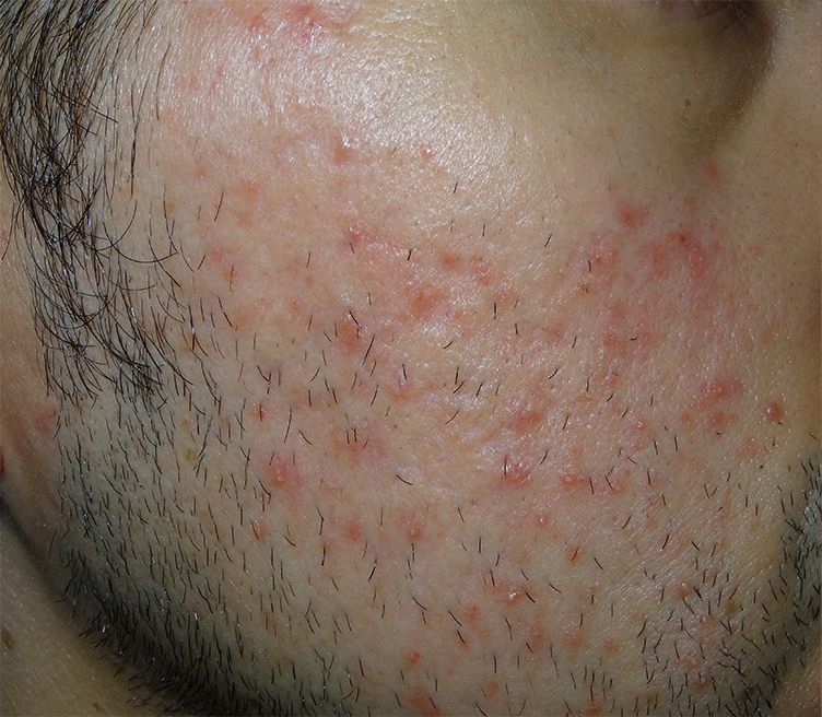 Close-up of a person's cheek with multiple small, red acne bumps and visible facial hair.
