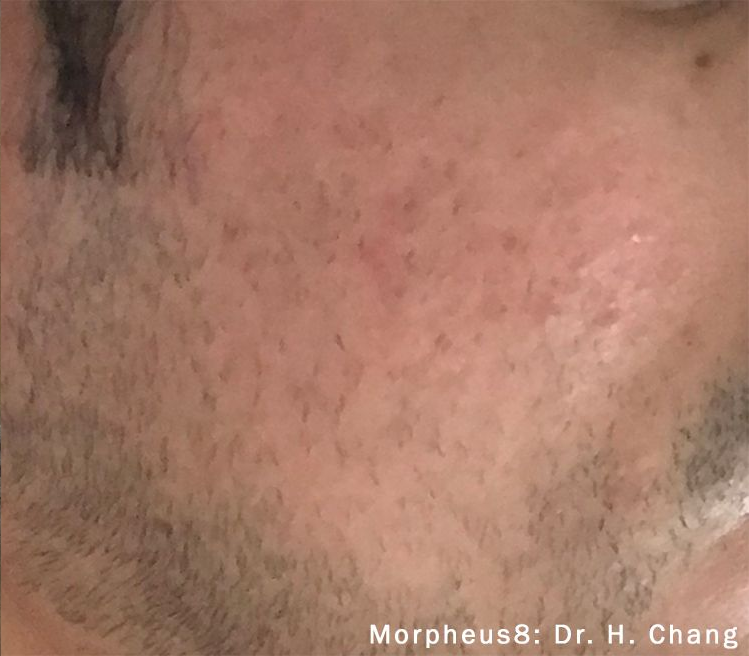 Close-up of a person's cheek and jawline with hair and minor skin discoloration, potential Morpheus8 treatment.