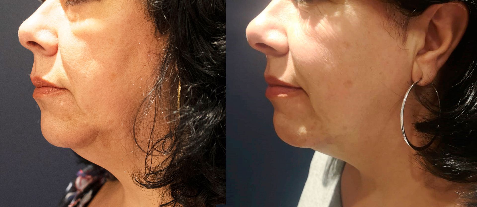 A before and after photo of a woman 's neck and face.