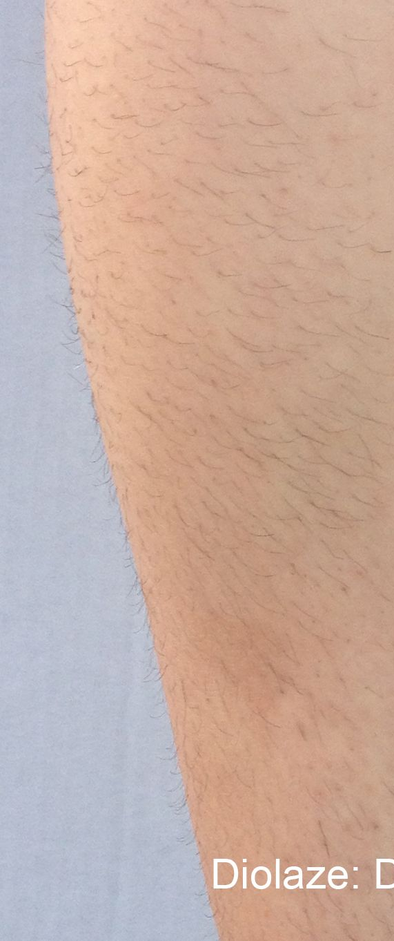 A close-up view of a hairy leg. Light brown skin with dark hairs.