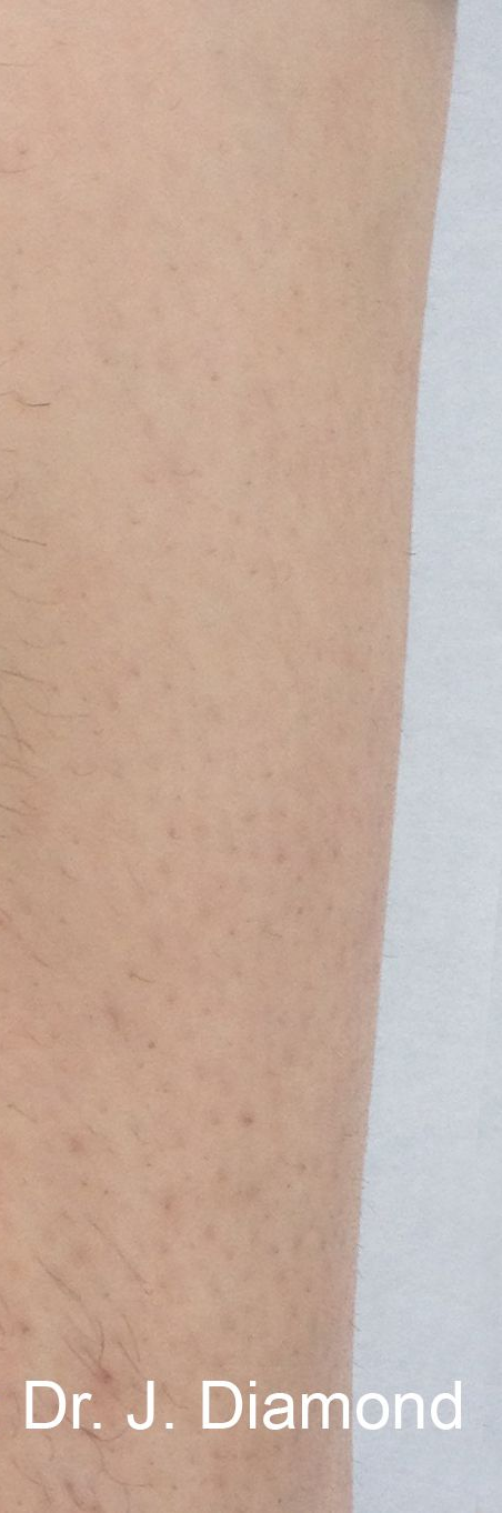 Close-up of human skin, light brown. Small bumps and hairs are visible.